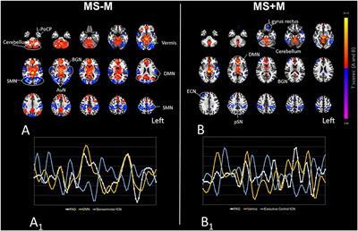 Migraine in Multiple Sclerosis Patients Affects Functional Connectivity of the Brain Circuitry Involved in Pain Processing